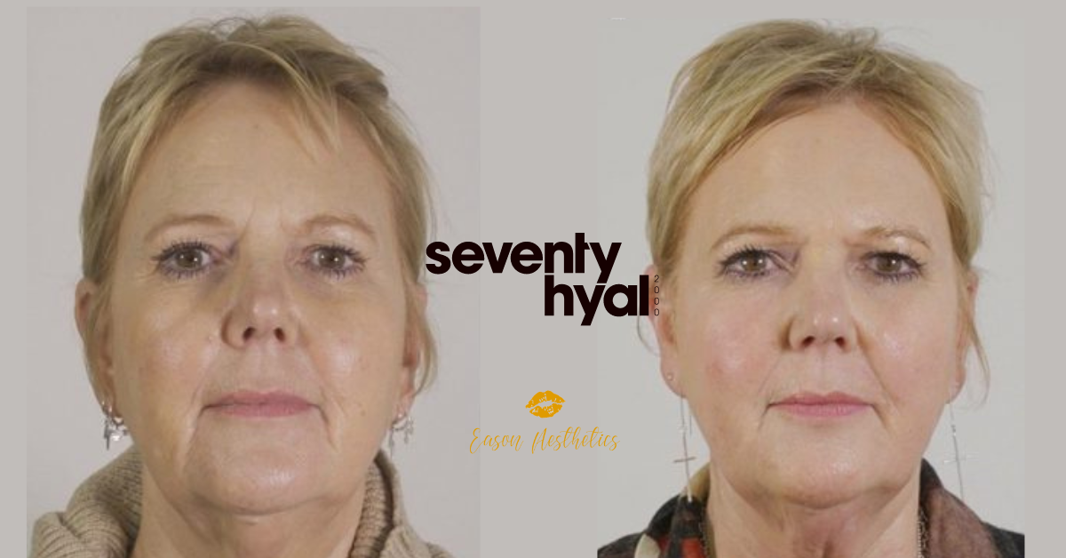 Seventy Hyal Before & After