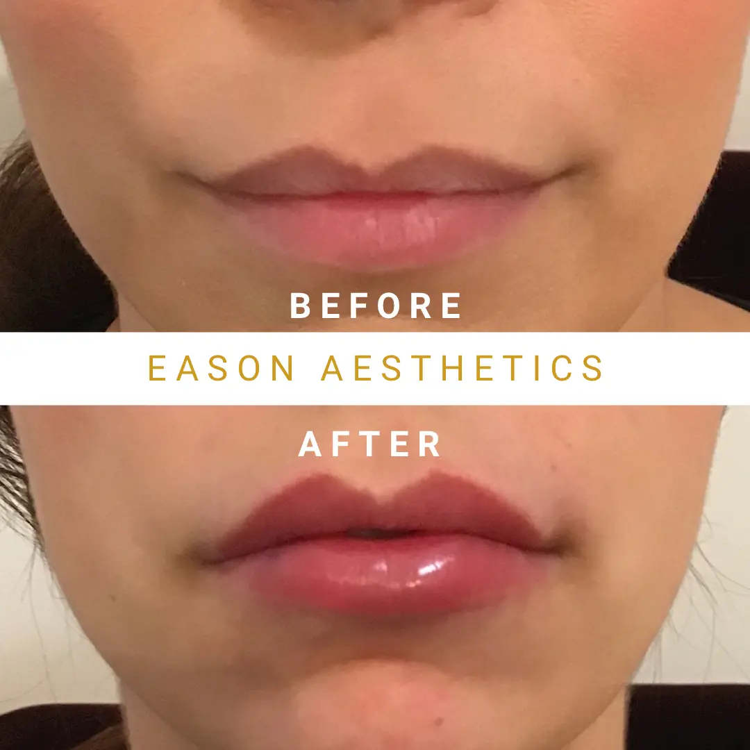 Natural Lip Fillers Before After