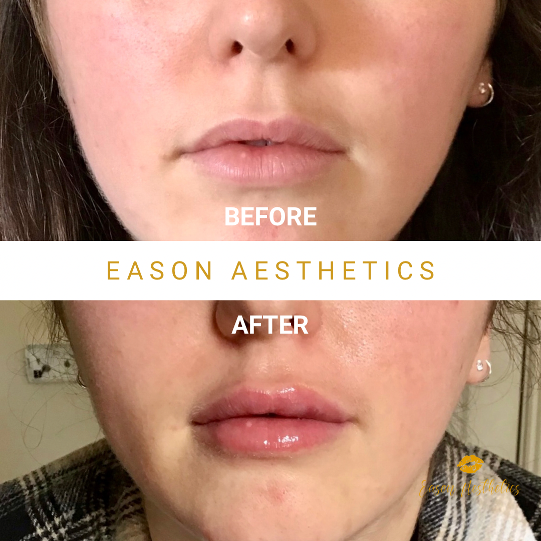 Revolax Lip Fillers Before & After