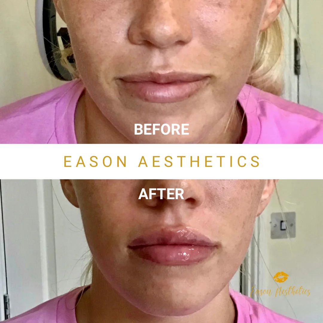 Lip Augmentation Before And After