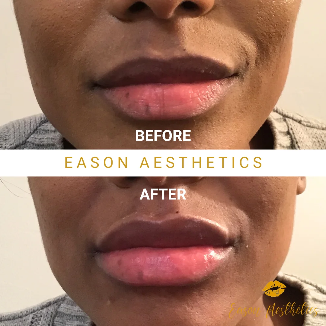 Black Female Lip Fillers Before And After