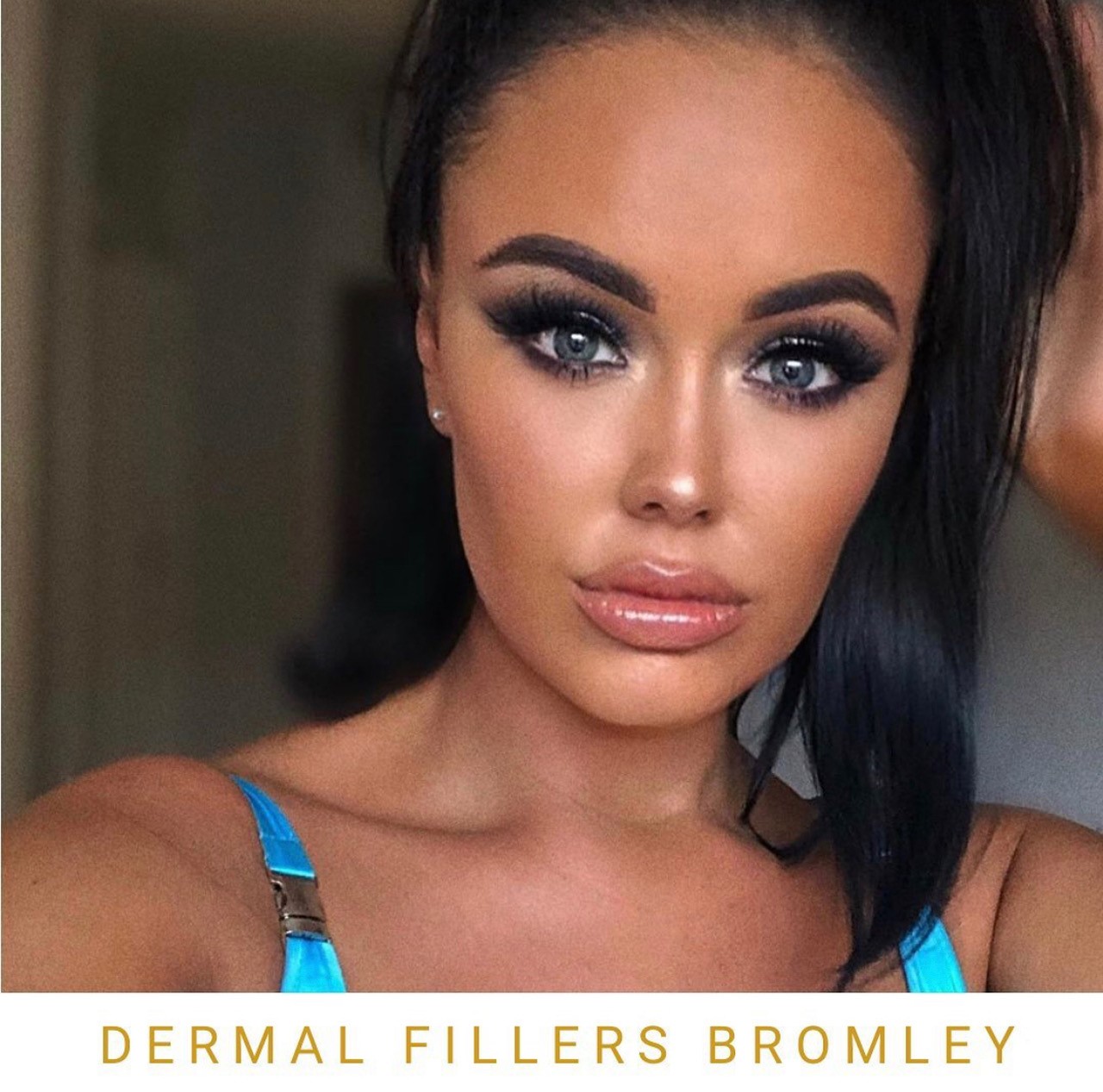 Lip Fillers Before & After Bromley Kent