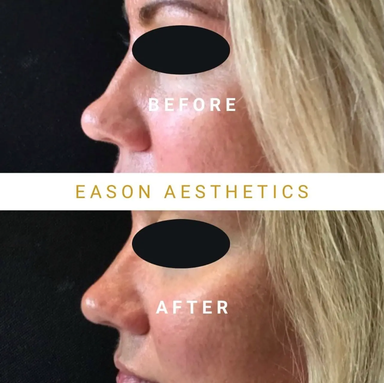 Rhinoplasty Before And After