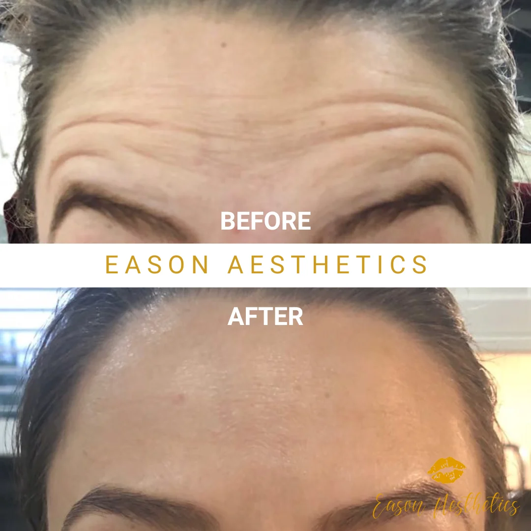 Womens Botox Before And After