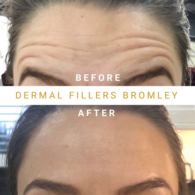 Womens Botox Before & After Photo