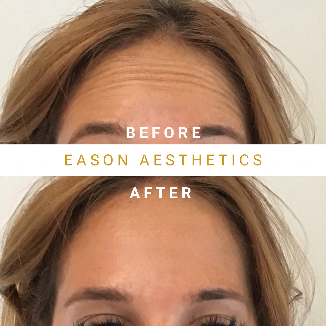 Forehead Botox Before & After