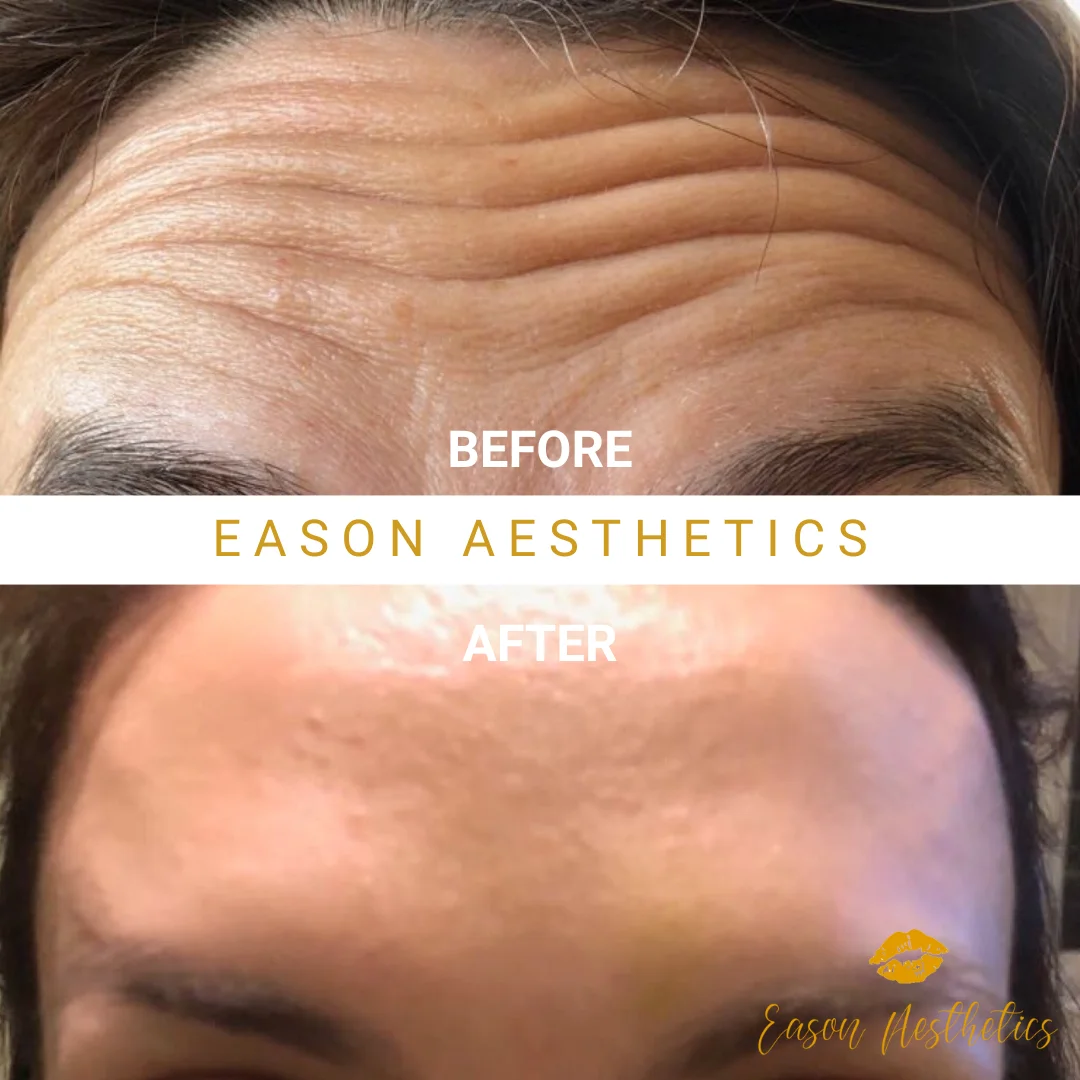 Womens Botox Forehead