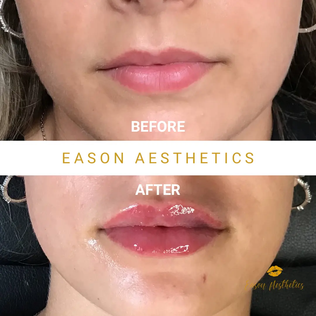 Lip Fillers Before And After Treatment