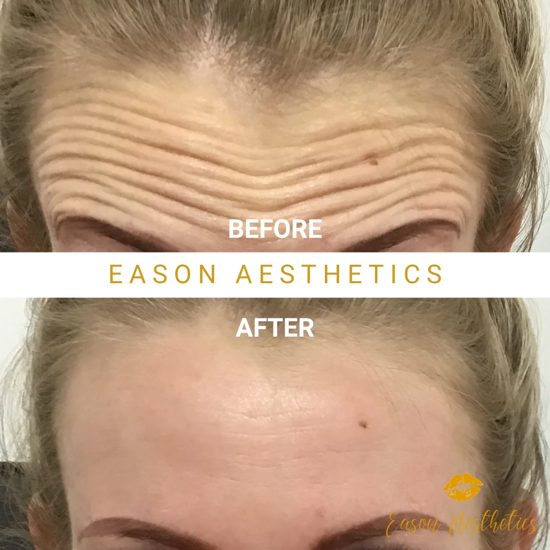 Female Botox Before And After Bromley