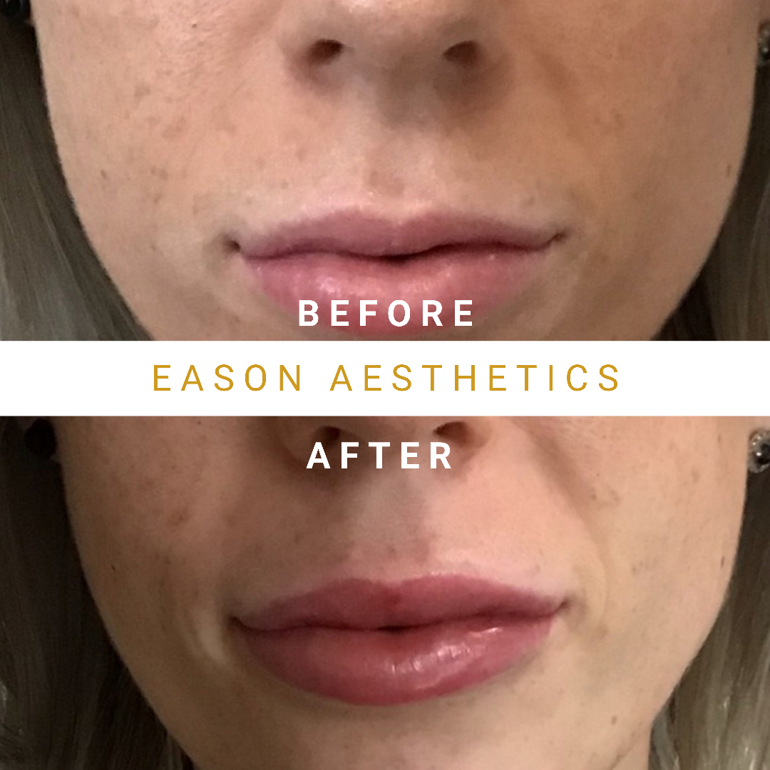 Lip Fillers Before & After Treatment Photo