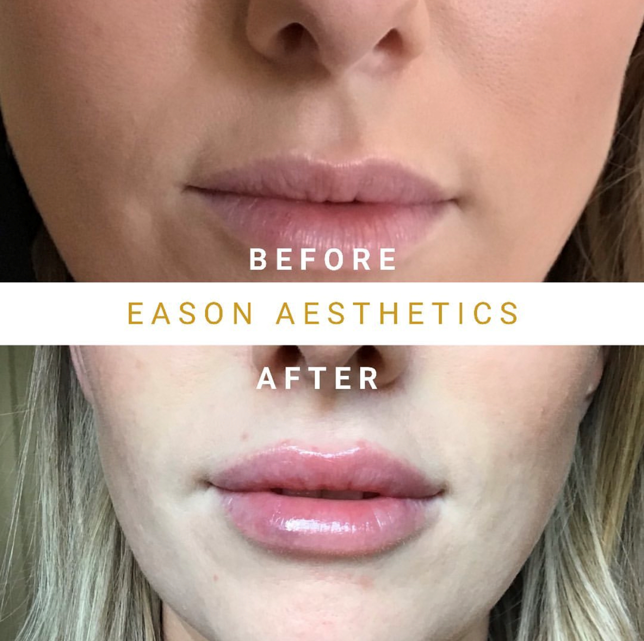 Lip Filler Treatment Before & After