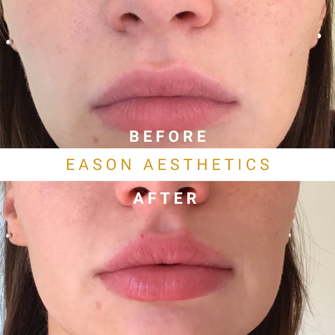 Lip Fillers Before & After Treatment
