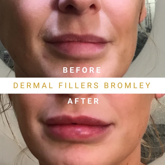 Lip Fillers - Eason Aesthetics