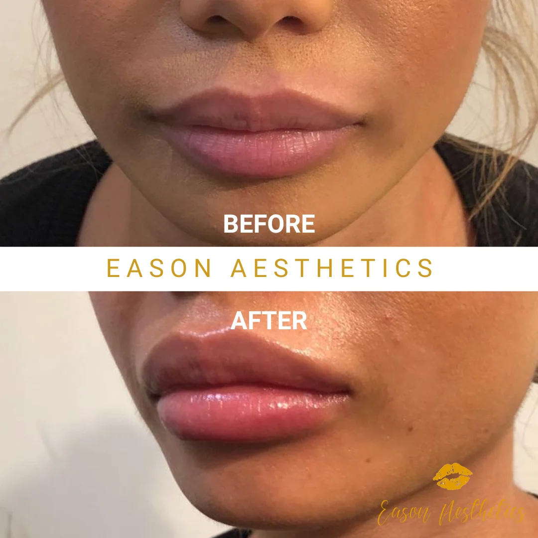 Womens Lip Fillers Before After