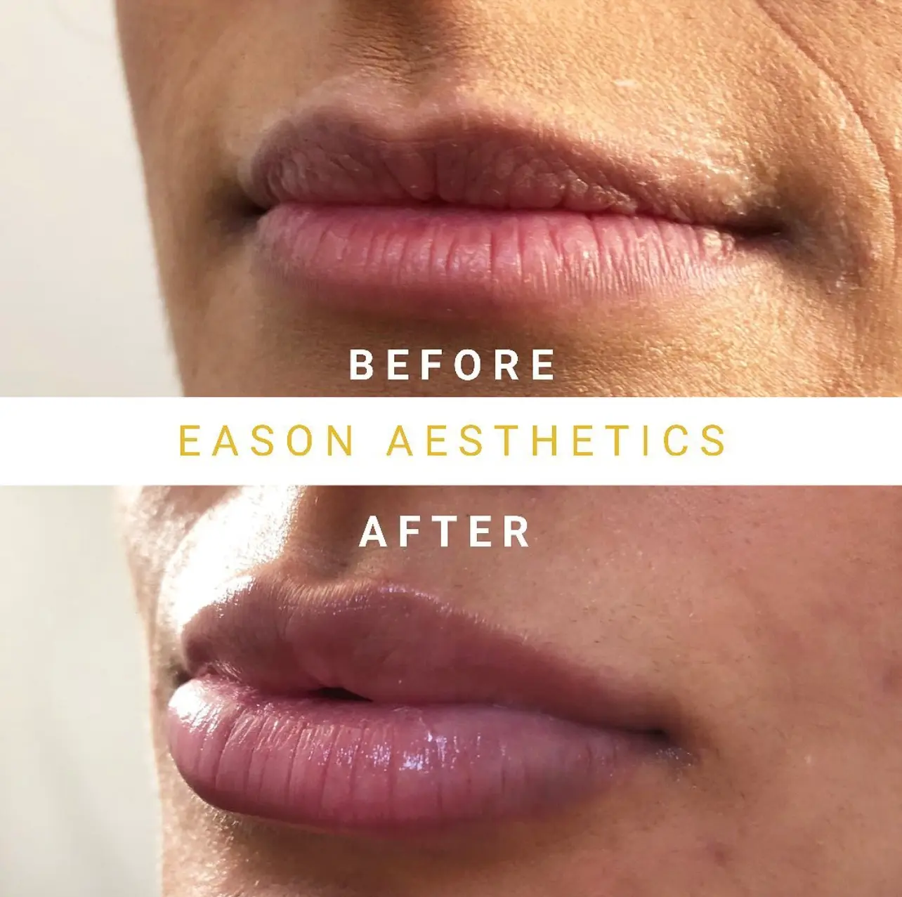 Lip Fillers Before After Treatment