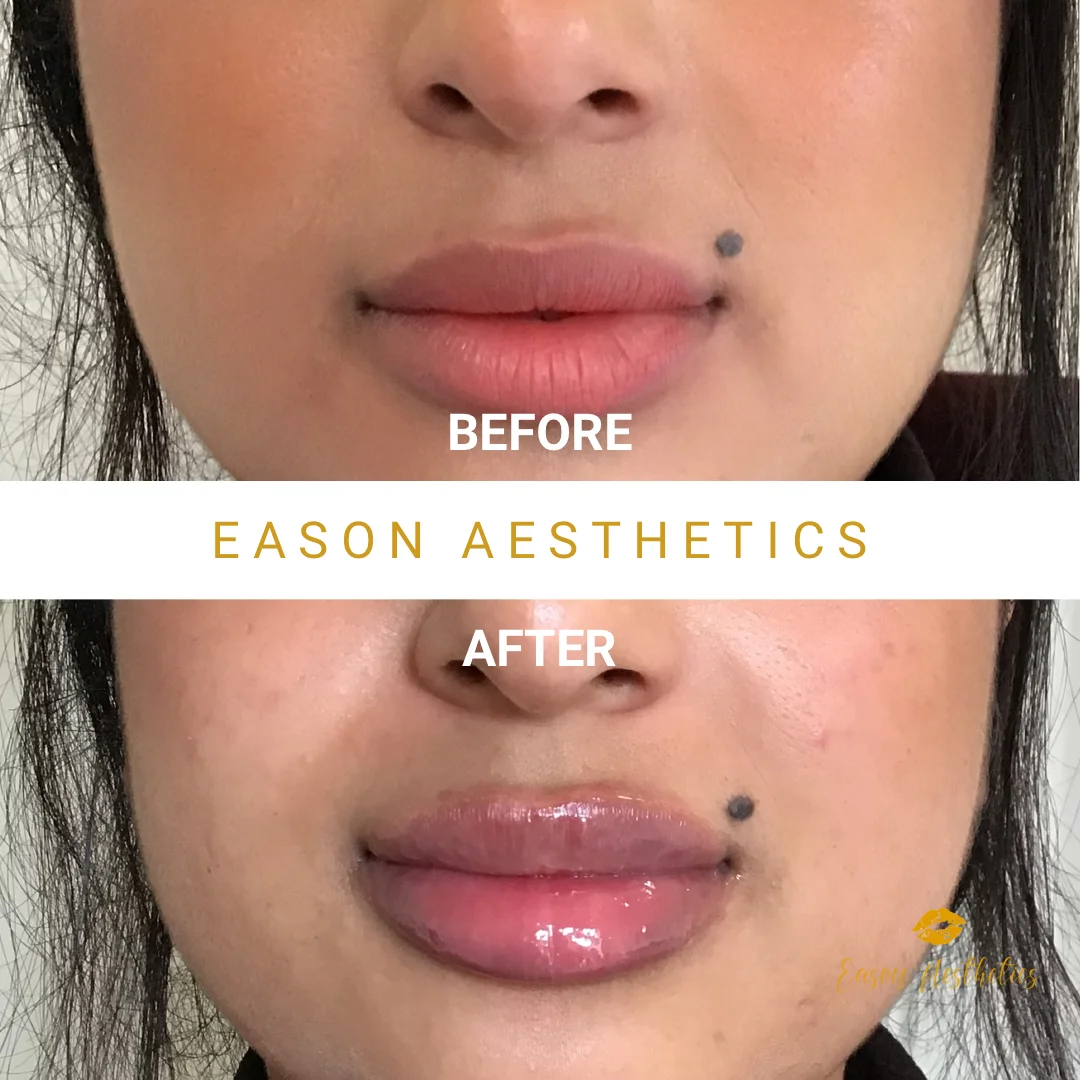 Lip Fillers Before And After Photo