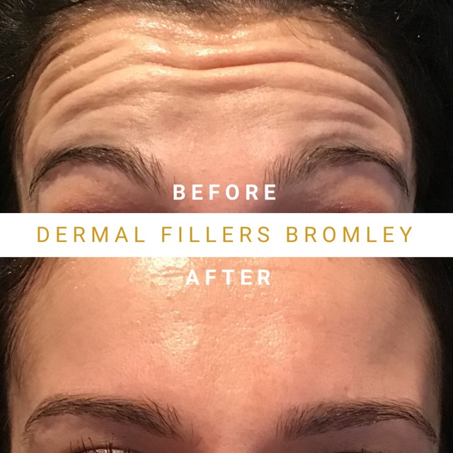 Botox Forehead Before & After