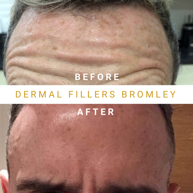 Mens Botox Forehead Before & After