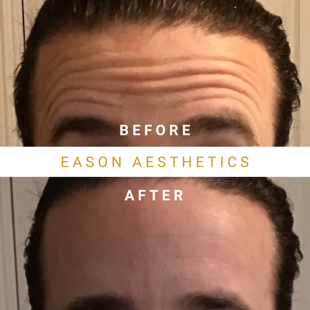 Anti-Wrinkle Treatment Male Before & After