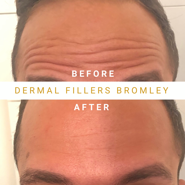 Mens Botox Before & AFter