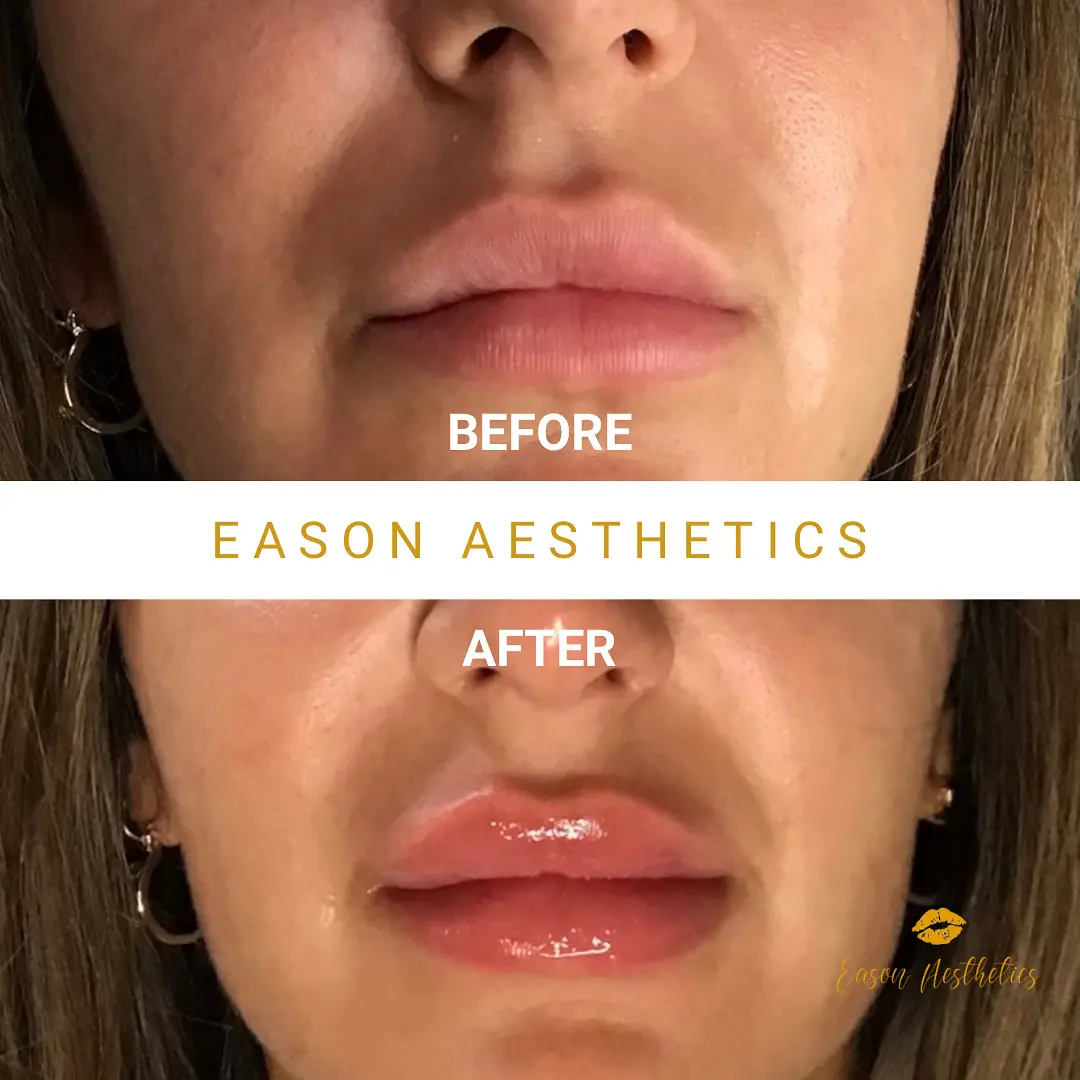 Lip Augmentation Before And After