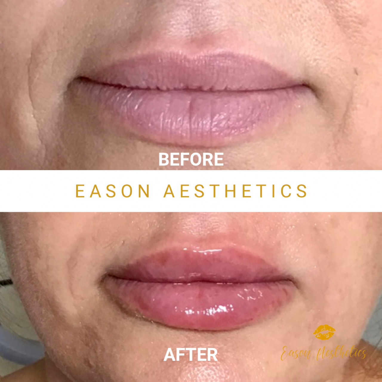 Lip Fillers Before & After Bromley